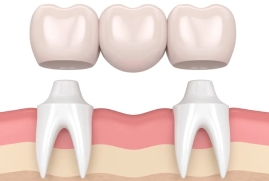 Dental Bridges